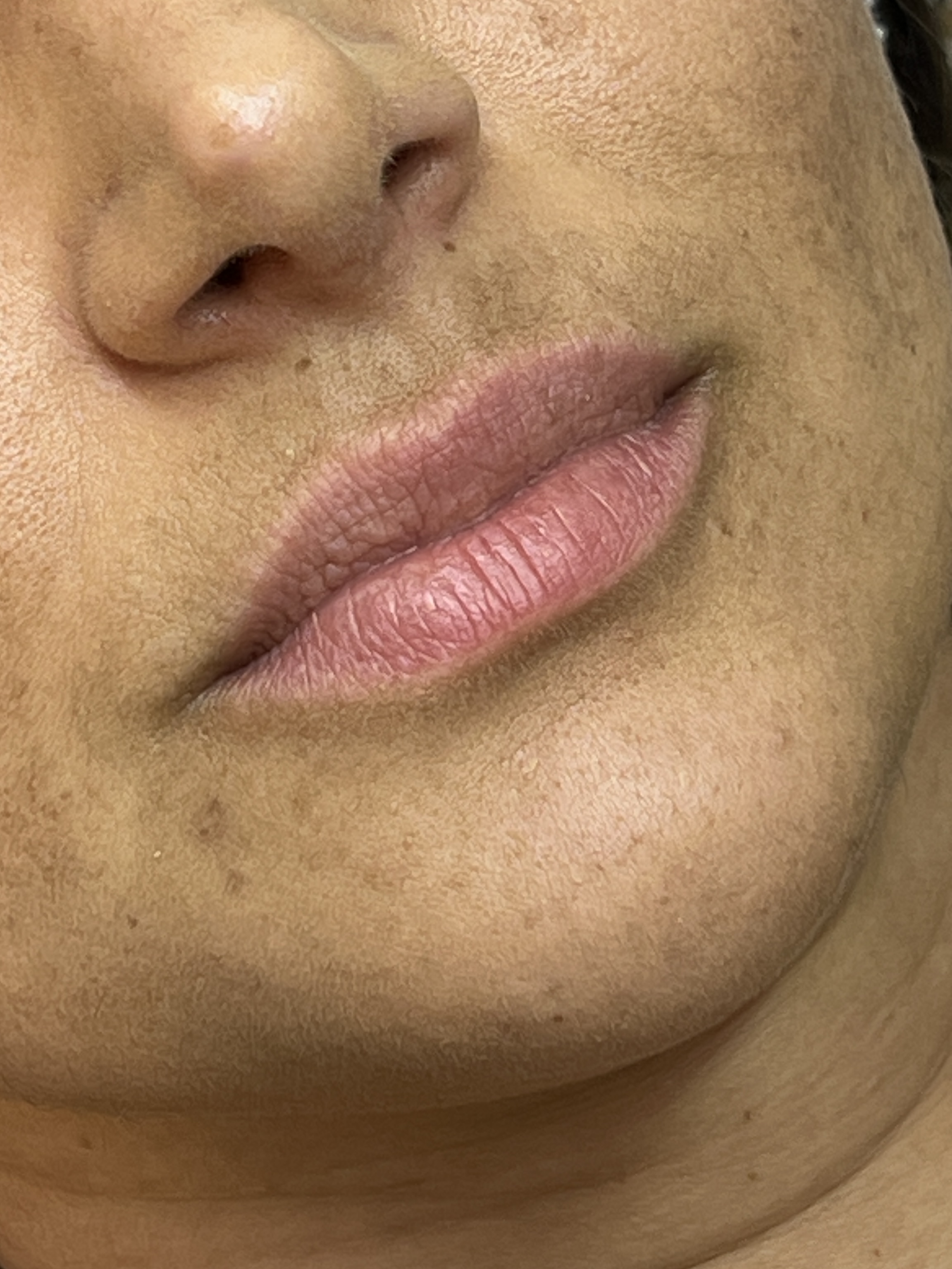 Cláudia antes do preenchimento labial